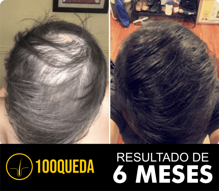 tratamento calvicie alopecia