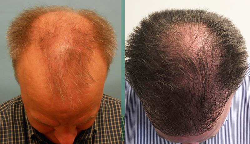 tratamento alopecia queda de fios