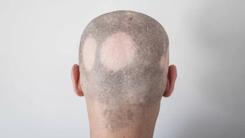covid-causa-alopecia.